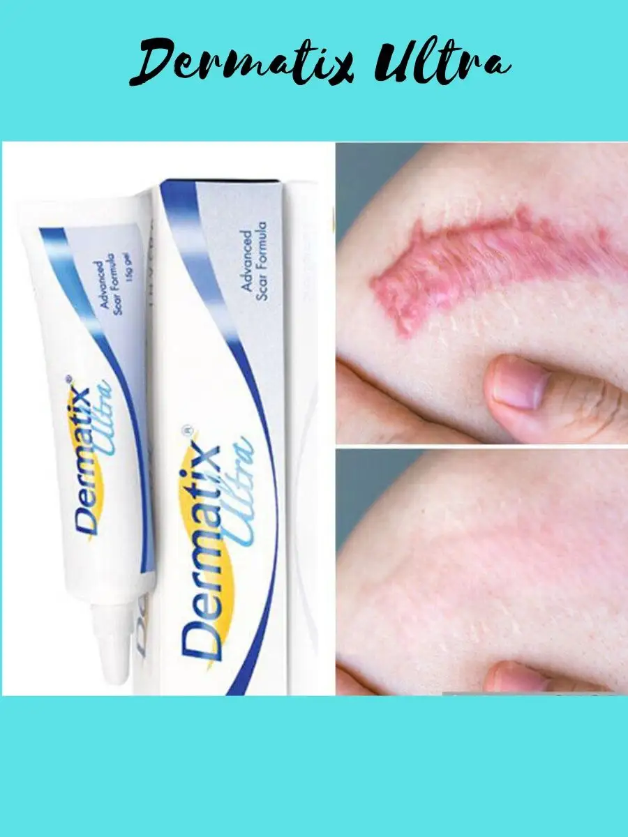 Dermatix ultra cream discount