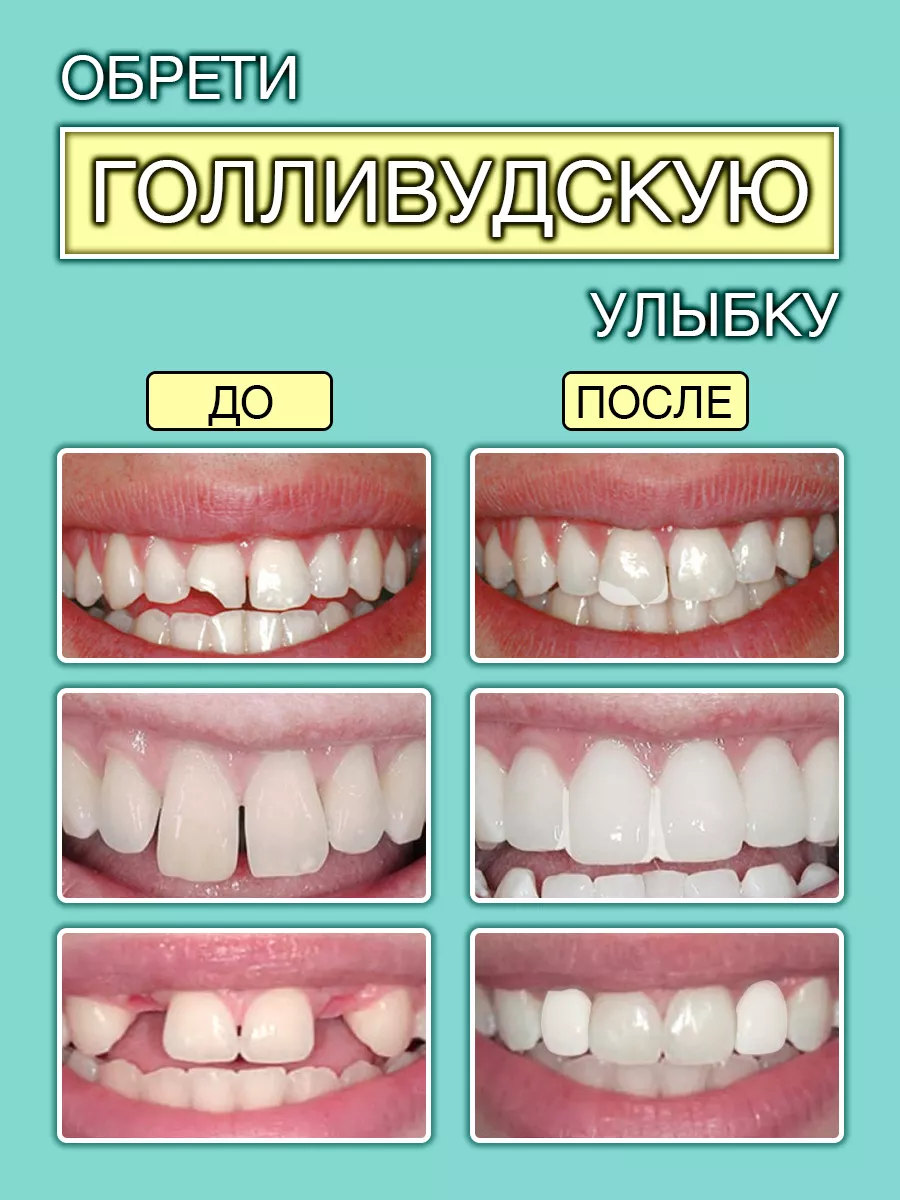 Временная пломба для зубов купить по цене 315 ₽ в интернет-магазине  Wildberries | 172874556