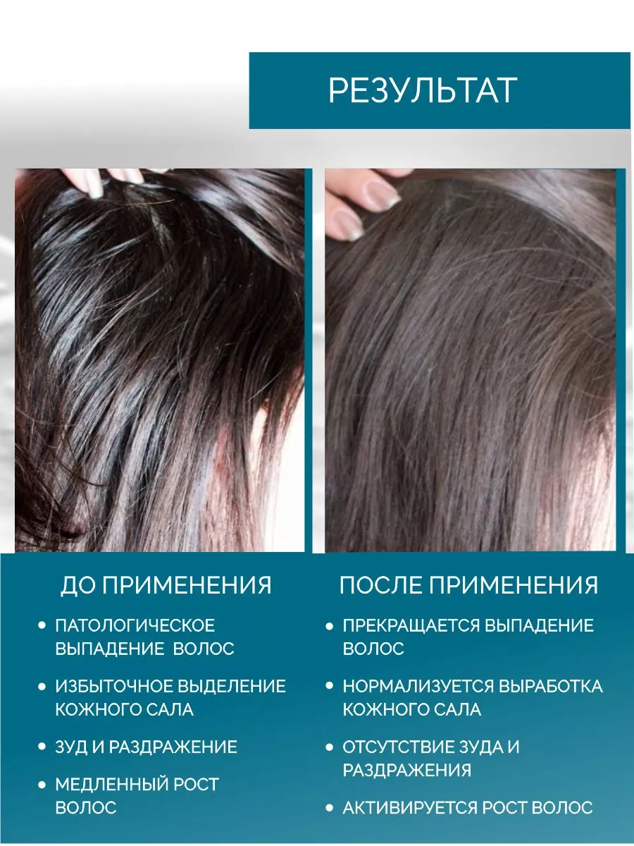 Очаговая алопеция - Cosmedica Clinic - Dr. Levent Acar