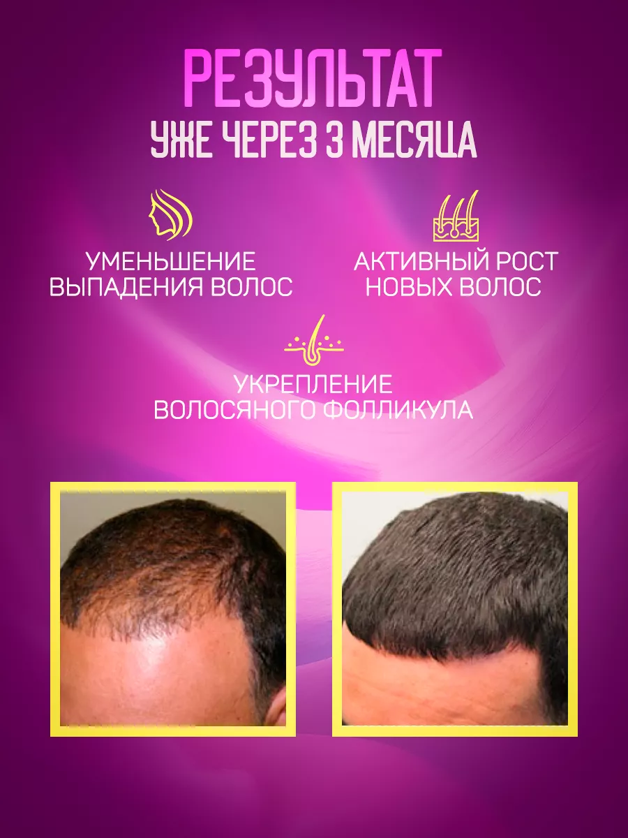 Сыворотка для роста волос Extrahair Extra Hair купить по цене 860 ₽ в  интернет-магазине Wildberries | 178898290